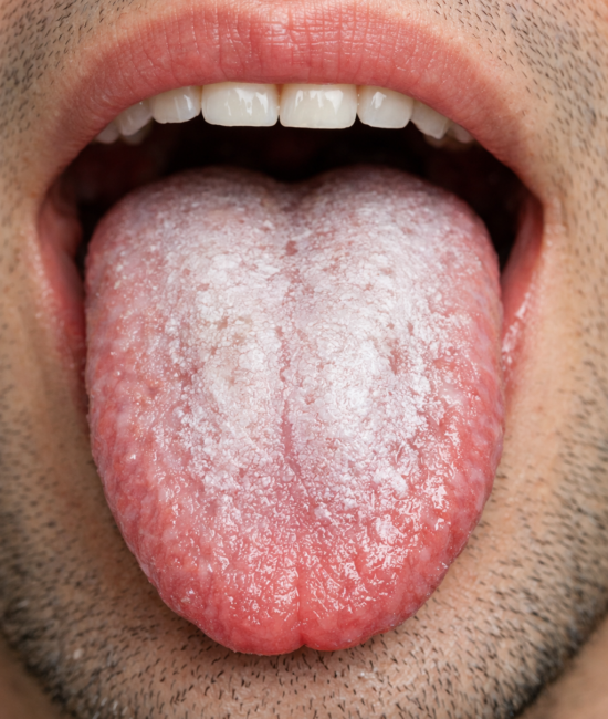 why is my tongue white